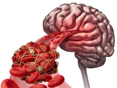 放血对脑血栓有帮助吗,舌头下面血管放血治脑血栓