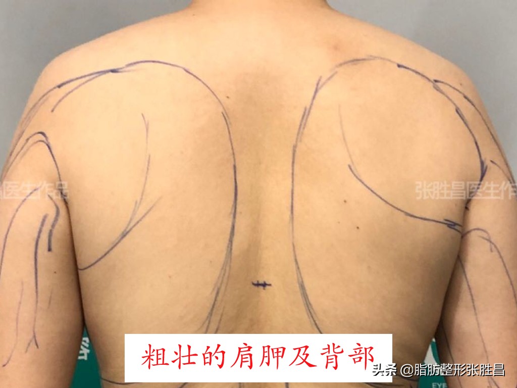 产后胖宝妈,产后肚子脂肪厚怎么减肥腹肌分离