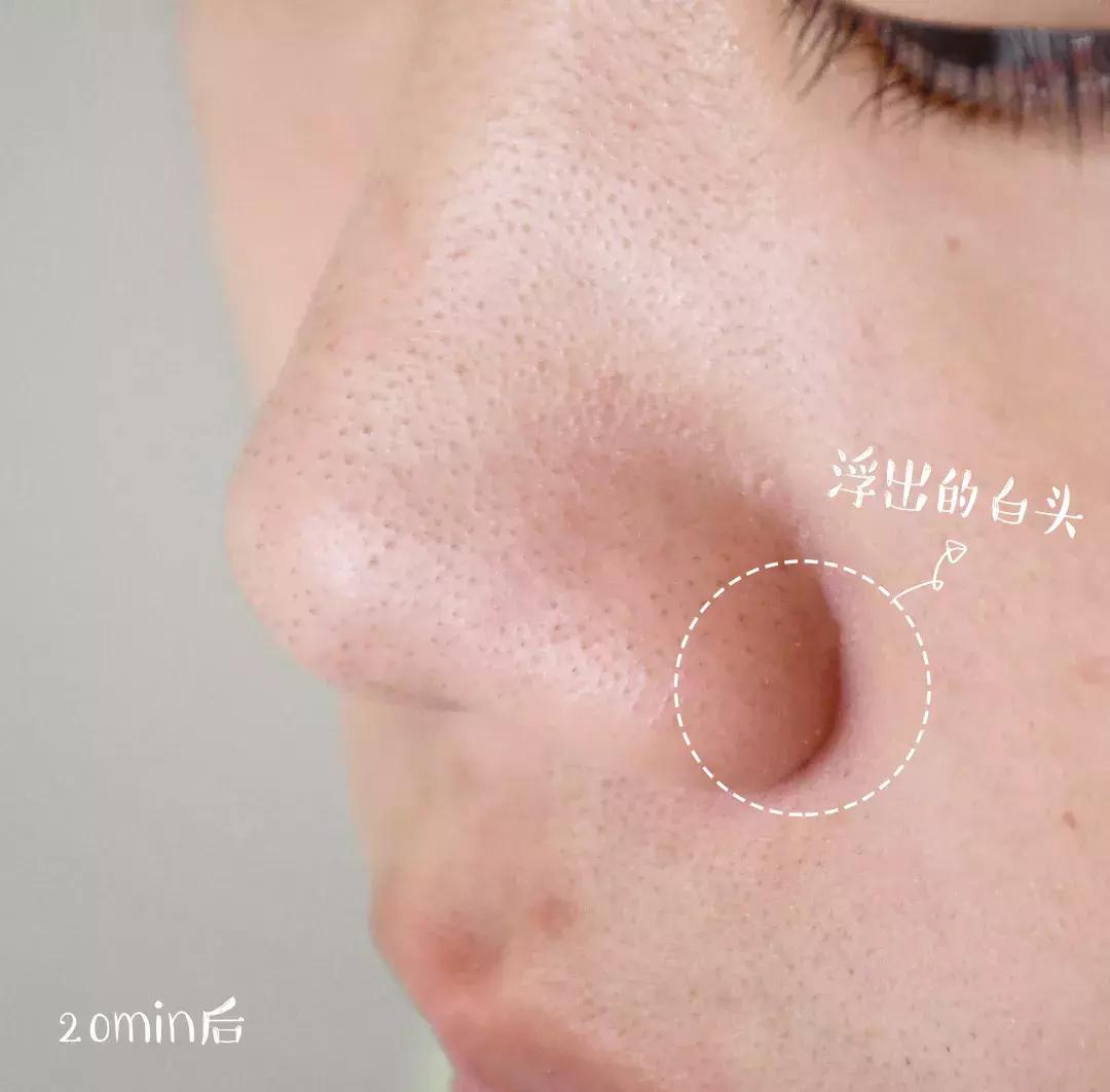 鼻子黑头清洁面膜哪个牌子好,哪种清洁面膜祛黑头粉刺有效果