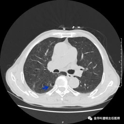 多发原发肺癌能根治吗,肺部原发性恶性肿瘤好治