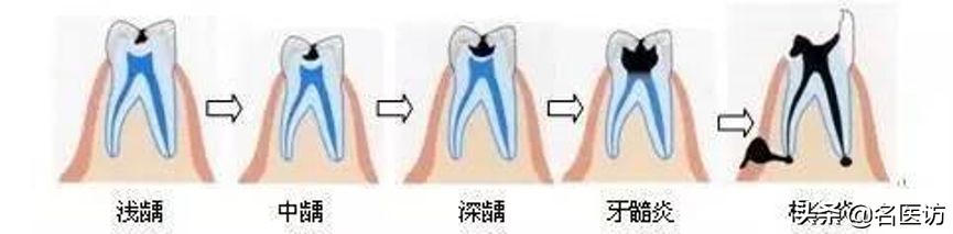 疫情牙痛怎么治疗,疫情期间牙痛用药怎么办