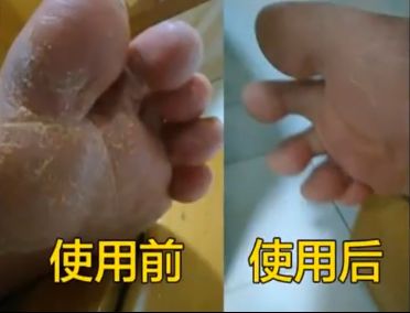 冬天脚后跟干裂用什么润脚霜,润足脚后跟干裂修复霜