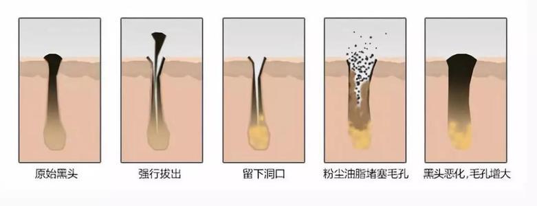 毛孔粗大怎么办教你一招根除,毛孔粗大怎么让毛孔变得细腻