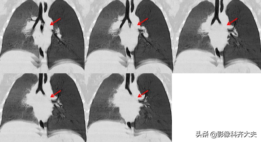 孩子支气管异物ct能查出吗,儿童支气管异物诊断方法