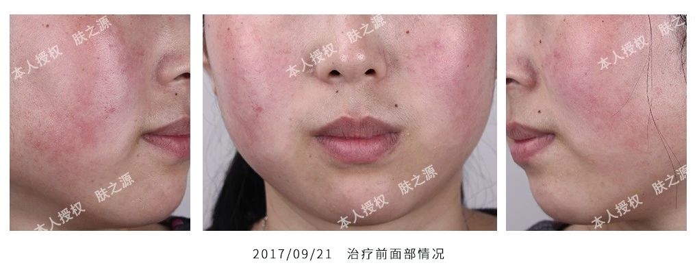 玫瑰痤疮患者自述,治疗玫瑰痤疮案例分享