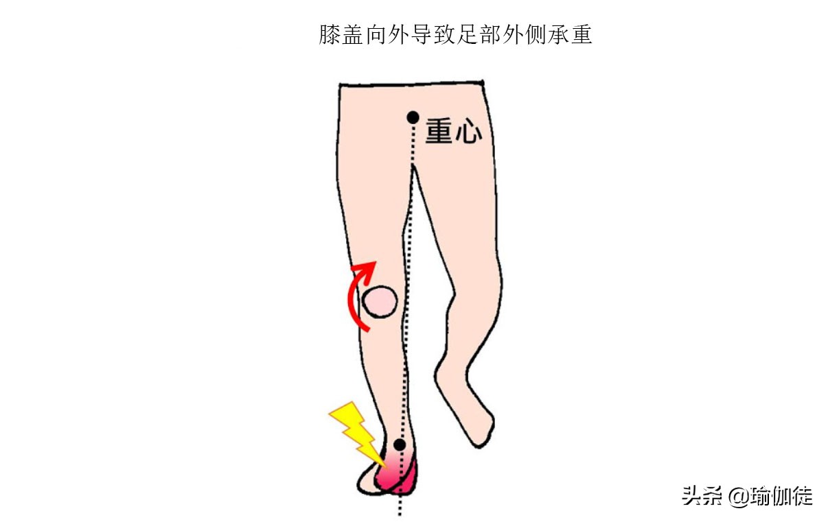 拇外翻大脚趾疼如何在家就能治,如何判断拇外翻造成的脚疼