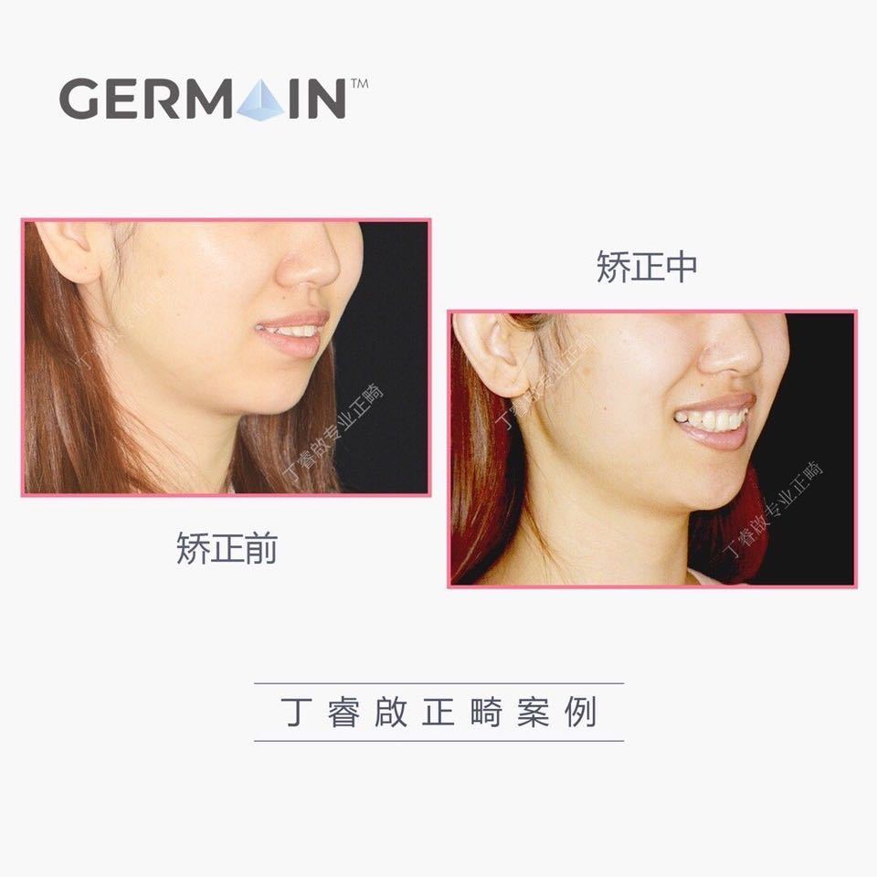 郑州牙齿矫正丁睿啟|下巴后缩病例合集