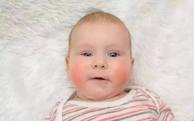 很多宝宝都会遇到湿疹的困扰,这两种方法轻松教你护理婴儿湿疹！