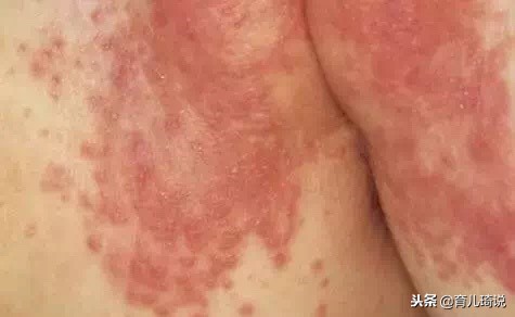 宝宝红屁股红肿发硬,宝宝的红屁股用什么方法治