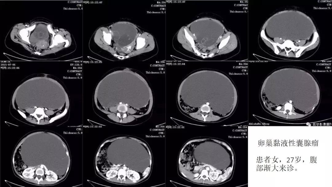 卵巢原发肿瘤的分析思路