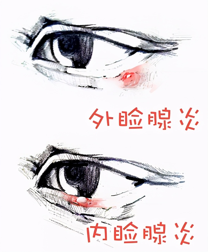 麦粒肿攻略,麦粒肿如何自己正确涂药膏