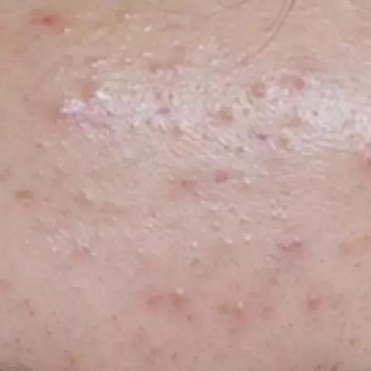 激光祛痣亲身经历和感受,激光祛痣亲身经历