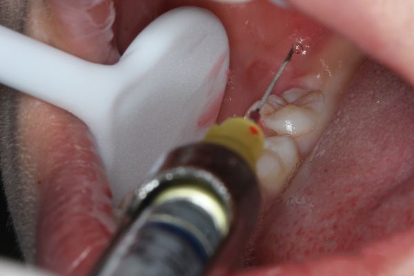 宝宝拔牙妈妈自责,为什么小孩拔牙打麻药还是痛