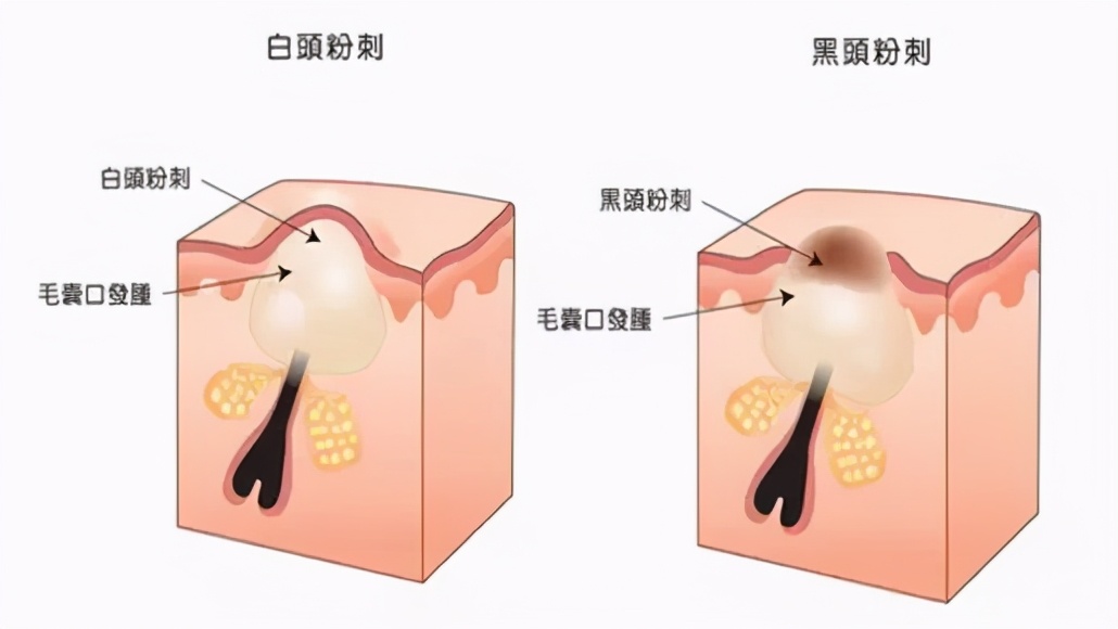 脸上长粉刺该怎么去除啊,脸上长粉刺怎么护肤比较好