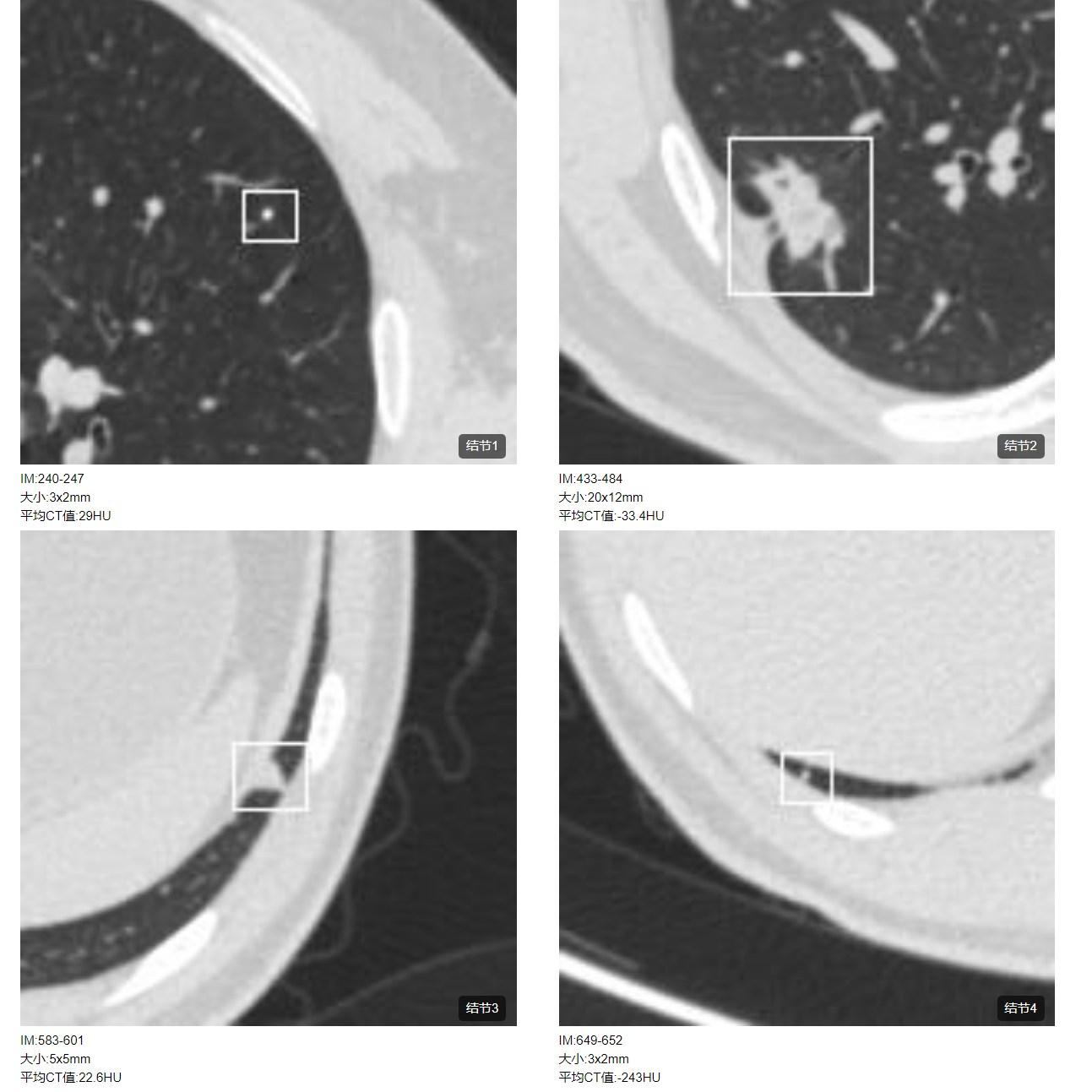 肺结节检查是薄层ct还是三维重建,肺结节检查用什么ct