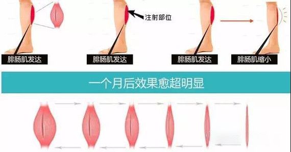 小腿粗壮打瘦腿针有用吗怎么瘦腿,有效瘦腿方法小腿