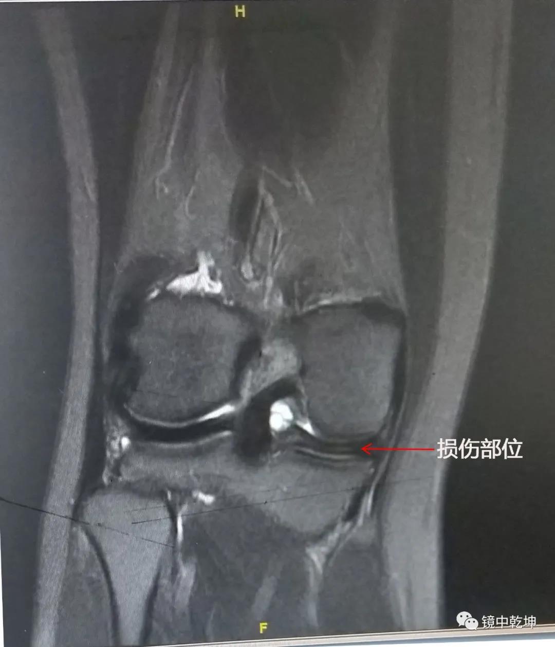 南大二附院系列科普：关节镜手术治疗膝关节半月板损伤