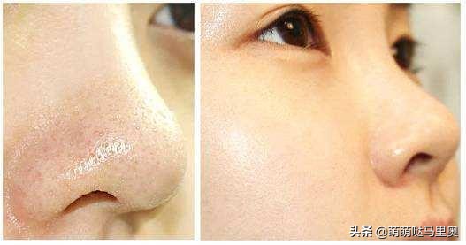 把鼻子里的黑头连根拔起,黑头怎么挤不痛又快