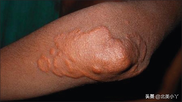 如何防治高脂血症,青少年如何预防高脂血症