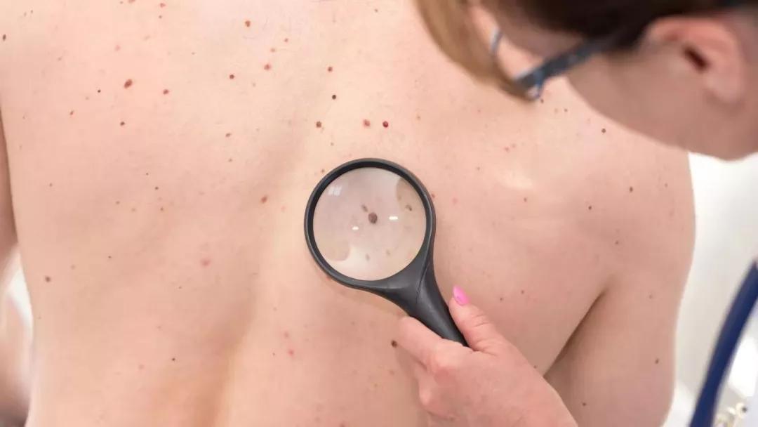 黑痣肿瘤,黑痣恶变的人