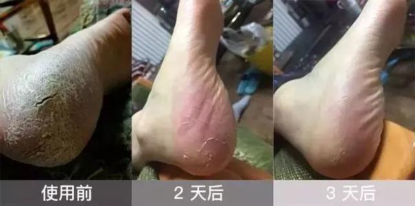 冬天手脚裂口,手脚冬天裂口怎么治疗