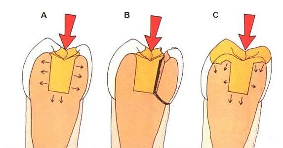 桩冠修复要做根管治疗吗,根管治疗加桩冠修复需要多长时间