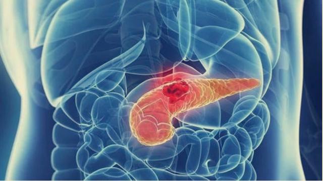 癌症之王胰腺癌视频,癌症之王胰腺癌