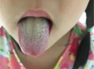 宝宝舌头地图舌是怎么回事,宝宝舌头辨别疾病图片