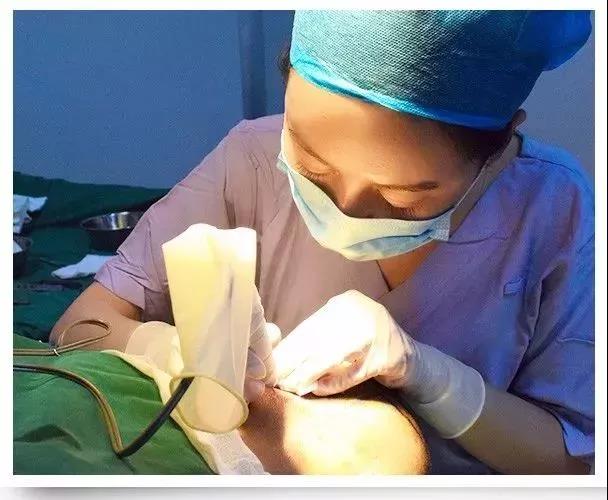 自体植发怎么移植,自体同源细胞移植植发