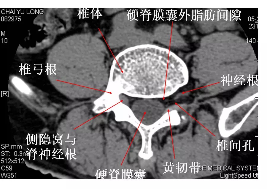 颈椎腰椎疾病ct及mri诊断,腰椎ct可以发现肠部病变吗