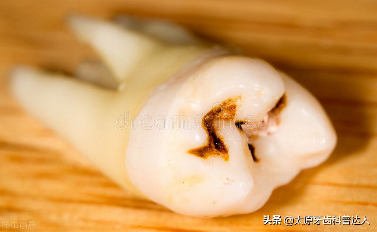 5岁小孩牙齿龋坏了治疗费用,给牙齿涂氟可以预防牙龋坏吗