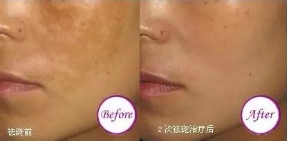 激光超皮秒祛斑后需要注意什么,激光祛斑术后注意事项有哪些