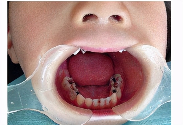 孩子龋齿牙疼需要治疗么,小孩龋齿牙疼的厉害怎么办