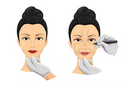 关于面部除皱术您想了解的问题,面部除皱术的七大类详解