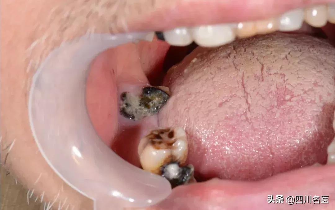 口腔溃疡超过2个月就是口腔癌,口腔溃疡变成唇炎