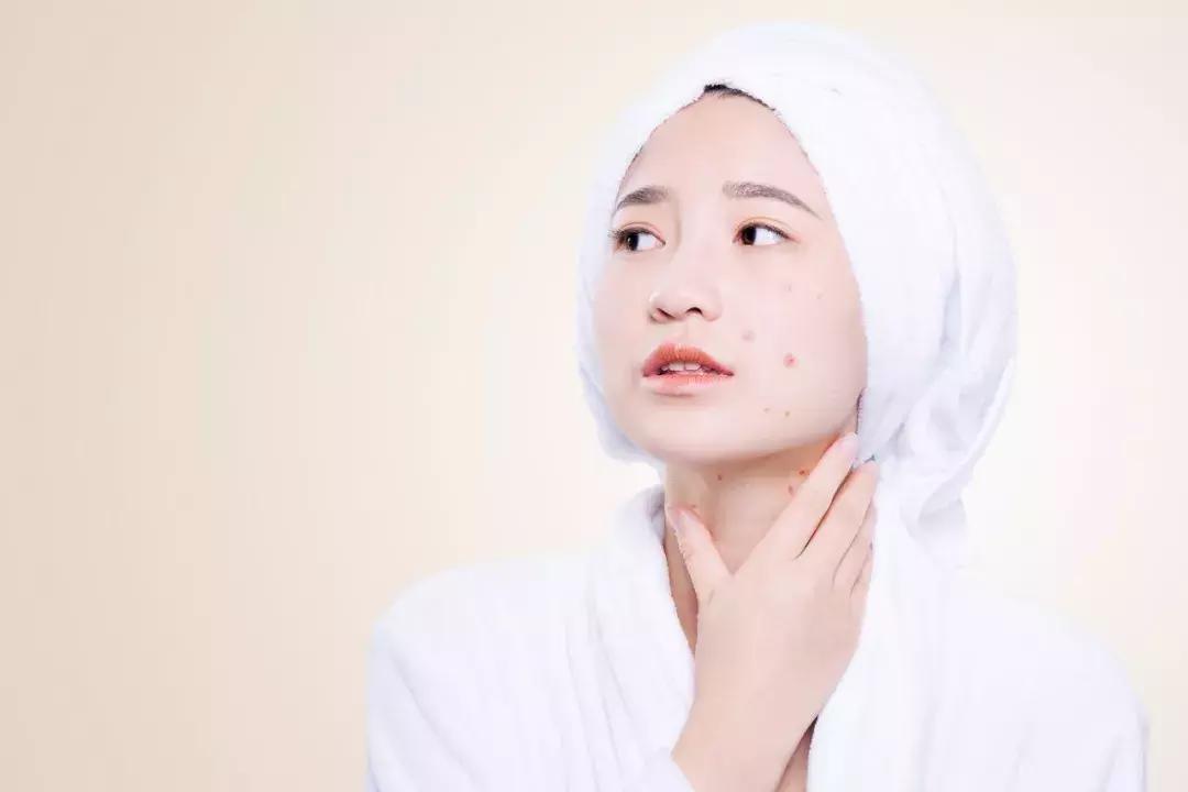 十年的痘痘都有救了,痘痘留下的坑还能修复吗