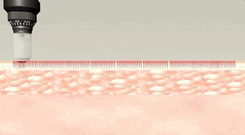 半永久粉底驻颜手法,脸部半永久粉底