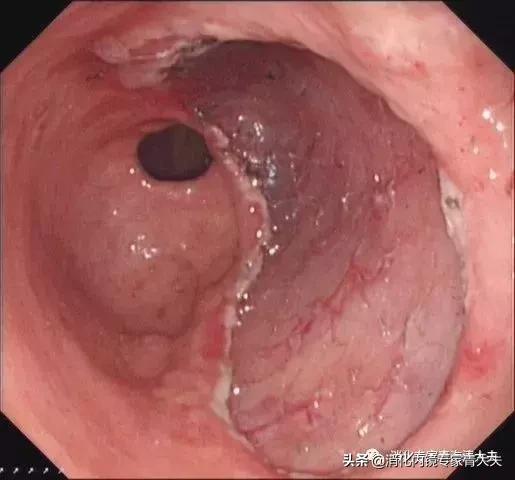 通过科普文章求治的一例胃窦后壁早癌