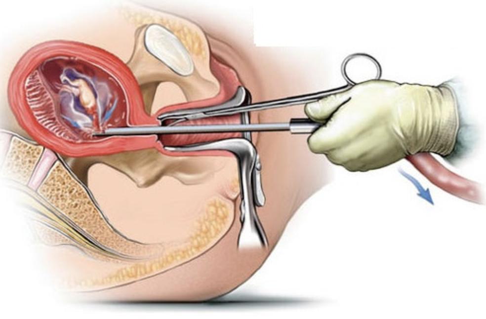 无痛人流和普通人流怎么选择,无痛人流和普通人流哪个保险
