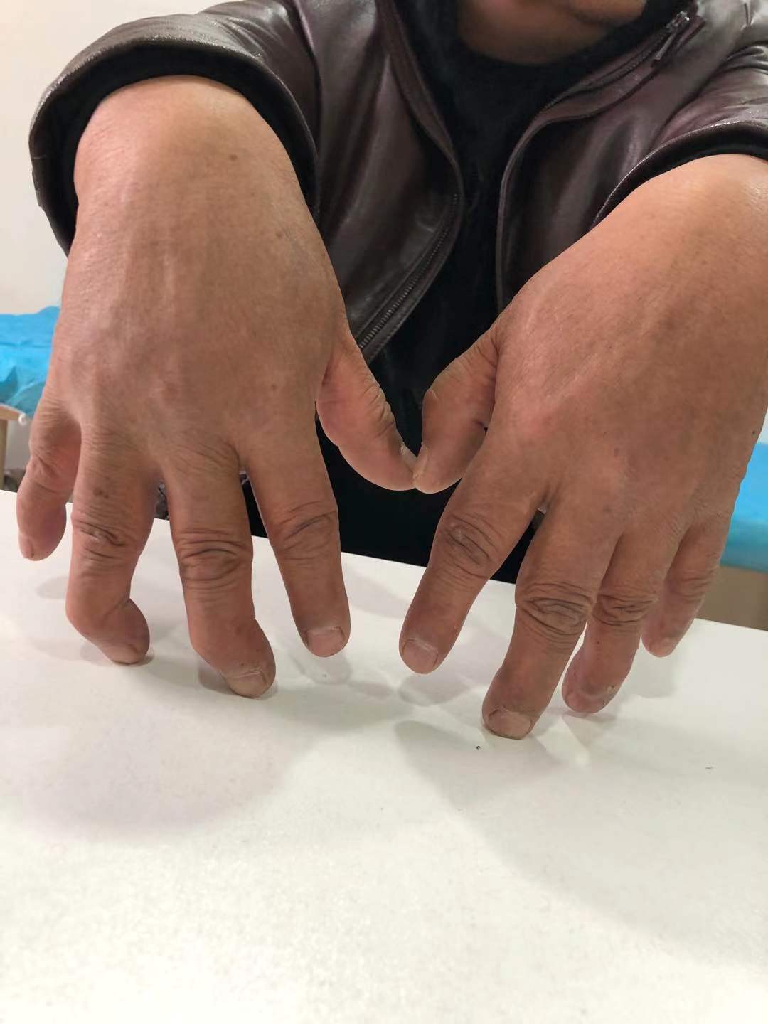 89.1%的类风湿患者都会骨密度减少，5年以上致残率几乎占一半