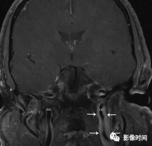 双侧颈动脉鞘间隙多发小淋巴结影,双侧颈动脉间隙多软组织密度结节