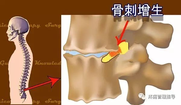 72岁老人腰疼还有骨刺该怎么治疗,老年人骨刺疼痛怎么治疗