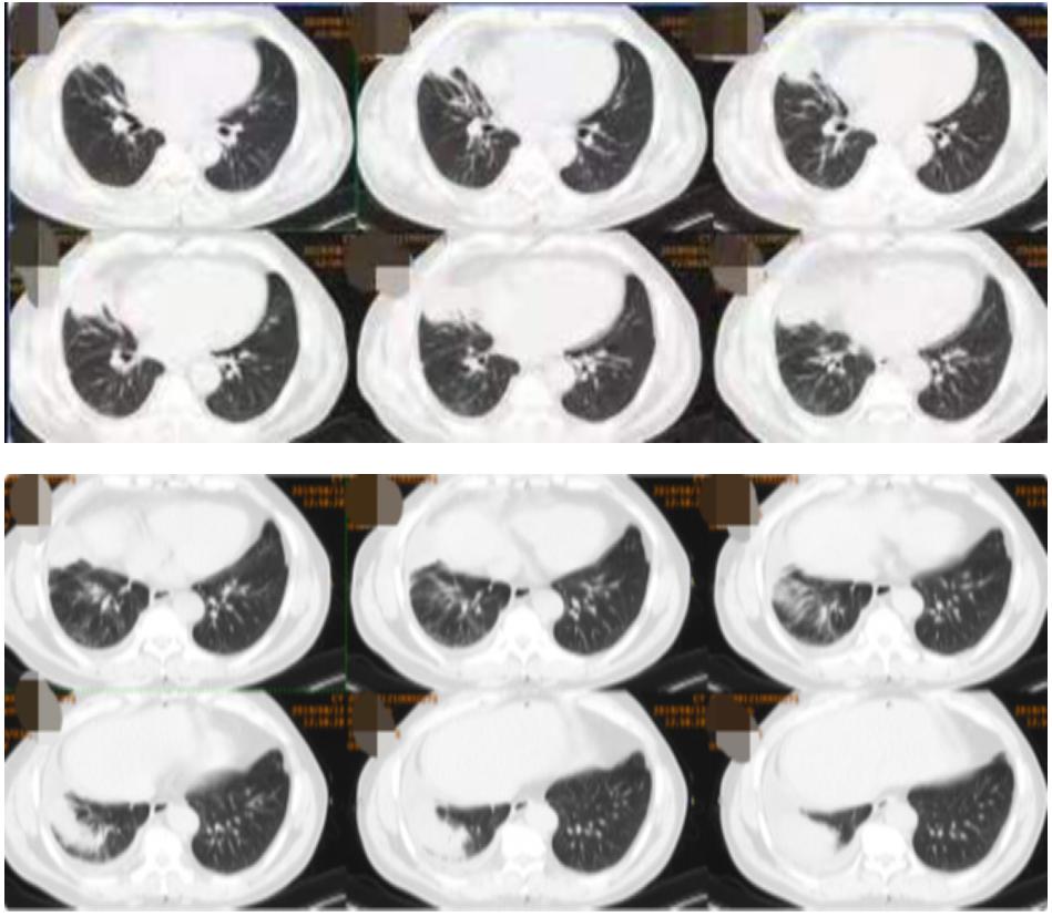 56岁男性发现双肺,56岁男性发现双肺数百个结节