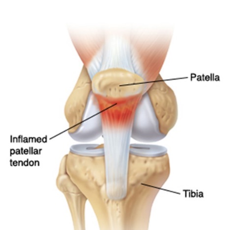 跑跳时膝盖不舒服,跑跳时膝盖内侧疼痛
