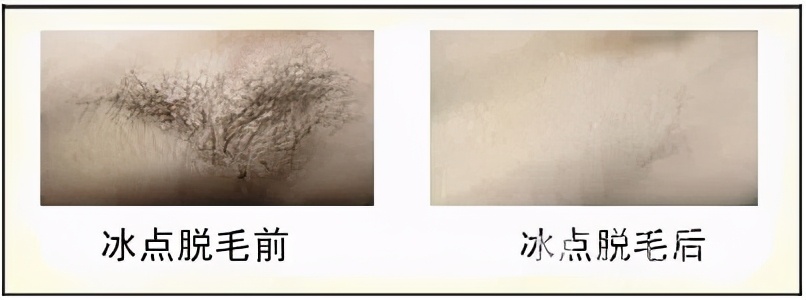 冰点脱毛仪哪个牌子脱毛效果最好,360脱毛和冰点脱毛有什么区别