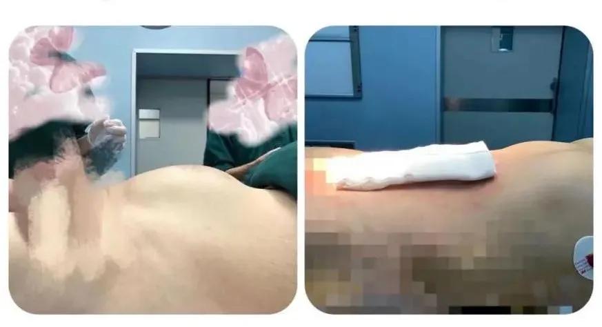 肚子大以为是胖却患肿瘤,以为自己胖其实是囊肿