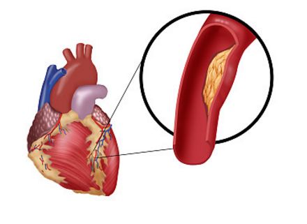 如何辨别真假心肌缺血,心肌缺血的亲身经历