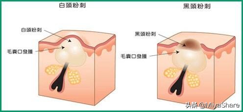 别傻傻的用手挤黑头,用手挤黑头后悔了怎么办
