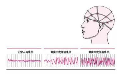 治疗癫痫修复脑神经的药有哪些,大脑癫痫怎么治