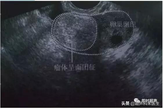 妇科常见疾病的超声诊断视频,超声常见疾病